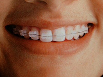 San Mateo Ceramic Braces
