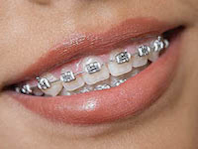 San Mateo Metal Braces